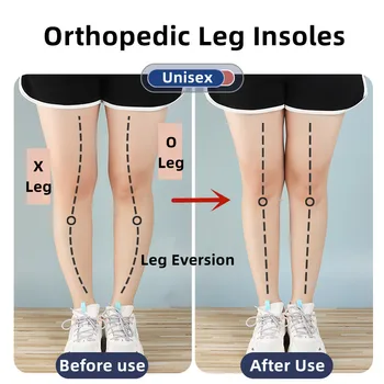 Силиконови Ортопедични Стелки за Краката O/X Тип Краката Корекция Вальгусной Деформация на Плантарна Фасциит Гел Стелки Магнитен Масаж Грижа за Краката